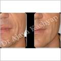 Cheek Augmentation Manufacturer Supplier Wholesale Exporter Importer Buyer Trader Retailer in New Delhi Delhi India